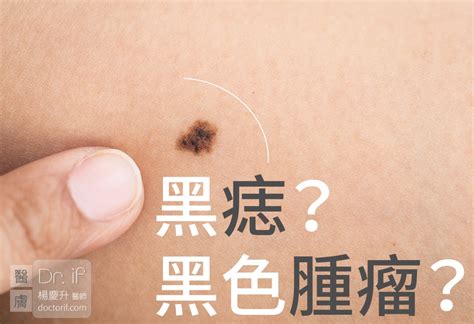 陰囊痣|陰囊上的痣：正常嗎？該去看皮膚科嗎？